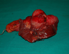 Specimen Showing Desected Gallbladder cancer